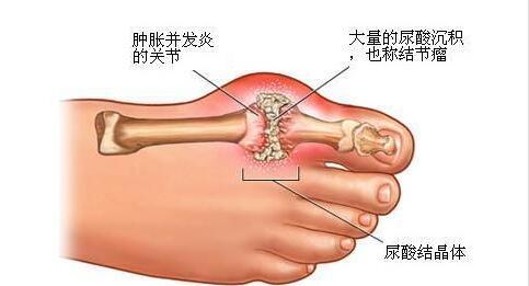 秋冬季節(jié)小心痛風(fēng)，在飲食方面該注意些什么？