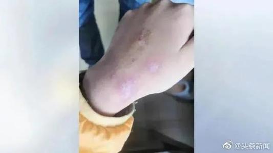 指甲抓傷臉、用烤熱的鏟刀燙臉……生母多次家暴女童被撤銷(xiāo)監(jiān)護(hù)權(quán)