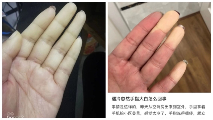 天氣一冷手指就發(fā)白僵硬 原來(lái)是一種極易被忽視的?。∮腥穗U(xiǎn)些被截肢