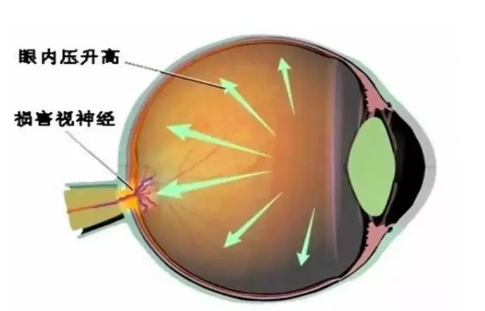 致盲率極高，青光眼呈現(xiàn)年輕化趨勢