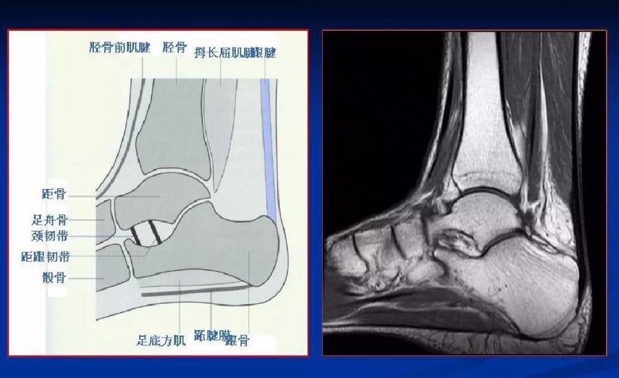 扭了腳脖子怎么還得做核磁？
