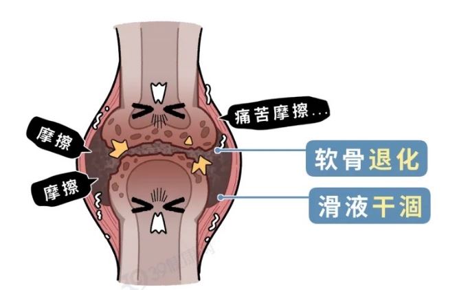 且行且珍“膝” 保護膝蓋建議做好這幾件事