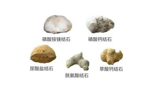 結(jié)石也分“門派”？成分不同，治法大不同！
