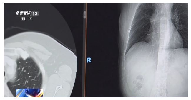 肺癌連續(xù)十年位居癌癥死亡率首位專家提醒：CT“早篩”是關(guān)鍵