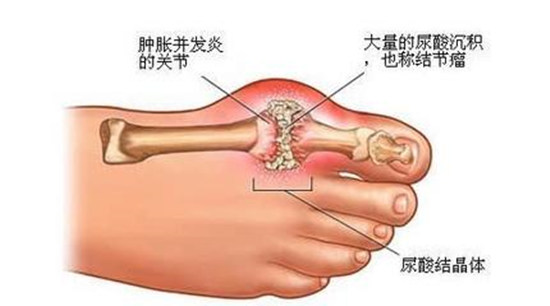 痛風不痛時 別不當回事