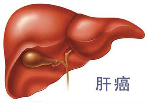 為什么肝癌早期難以發(fā)現(xiàn)？